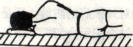 图 二　 低枕致颈椎侧弯